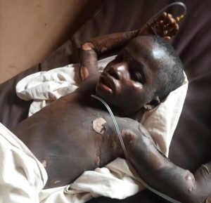 burnt 10-year old daughter